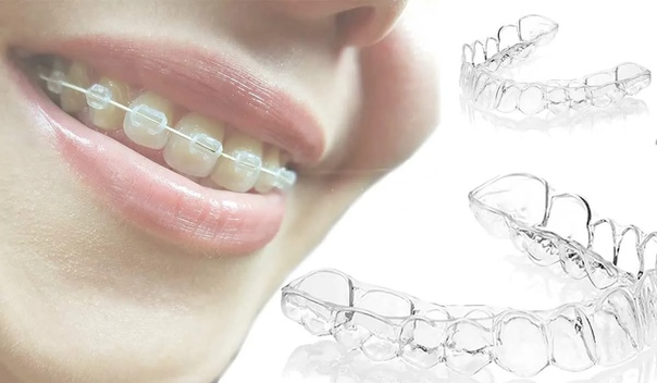 Global Aesthetic Orthodontic Bracket Market