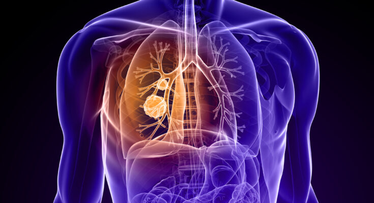 Pulmonary Embolism Therapeutics Market